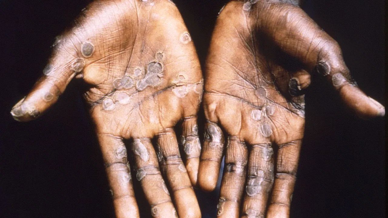 বিশ্বজুৰি MPOX ভাইৰাছৰ আতংকঃ ভাৰততো বিয়পিব পাৰে নেকি এই ভাইৰাছ! বিশ্বজুৰি MPOX ভাইৰাছৰ আতংকঃ ভাৰততো বিয়পিব পাৰে নেকি এই ভাইৰাছ!