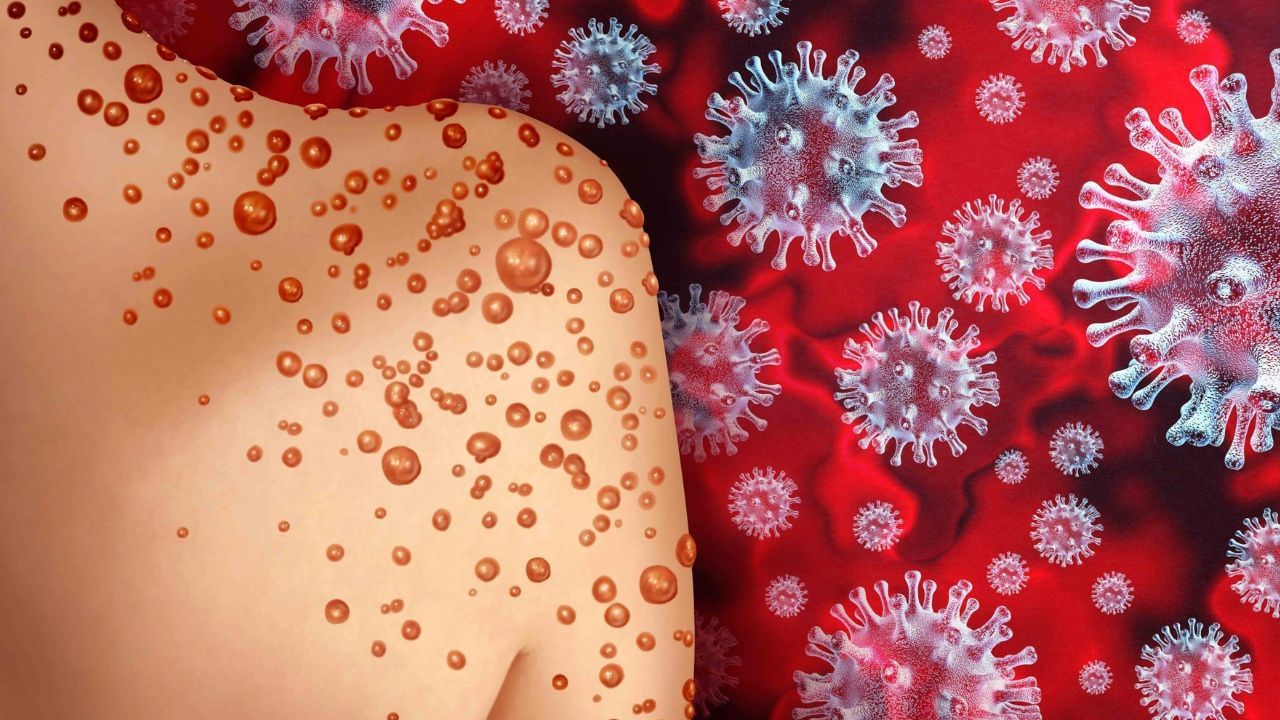 ক’ভিদৰ দৰেই মহামাৰীৰ ৰূপ ল’ব নেকি Monkeypox- এ? আফ্ৰিকাত আগ্ৰাসী হৈ উঠা কি এই Monkeypox, চাওক সবিশেষ… ক’ভিদৰ দৰেই মহামাৰীৰ ৰূপ ল’ব নেকি Monkeypox- এ? আফ্ৰিকাত আগ্ৰাসী হৈ উঠা কি এই Monkeypox, চাওক সবিশেষ…