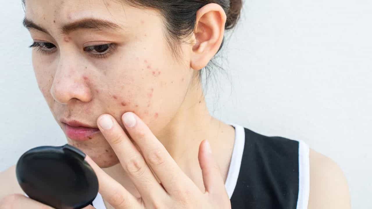 এইবাৰ বৃদ্ধি পাইছে ‘শ্লেপ্ড চিক’ ৰোগঃ কিয় হয় এই ৰোগ, চাওক সবিশেষ....