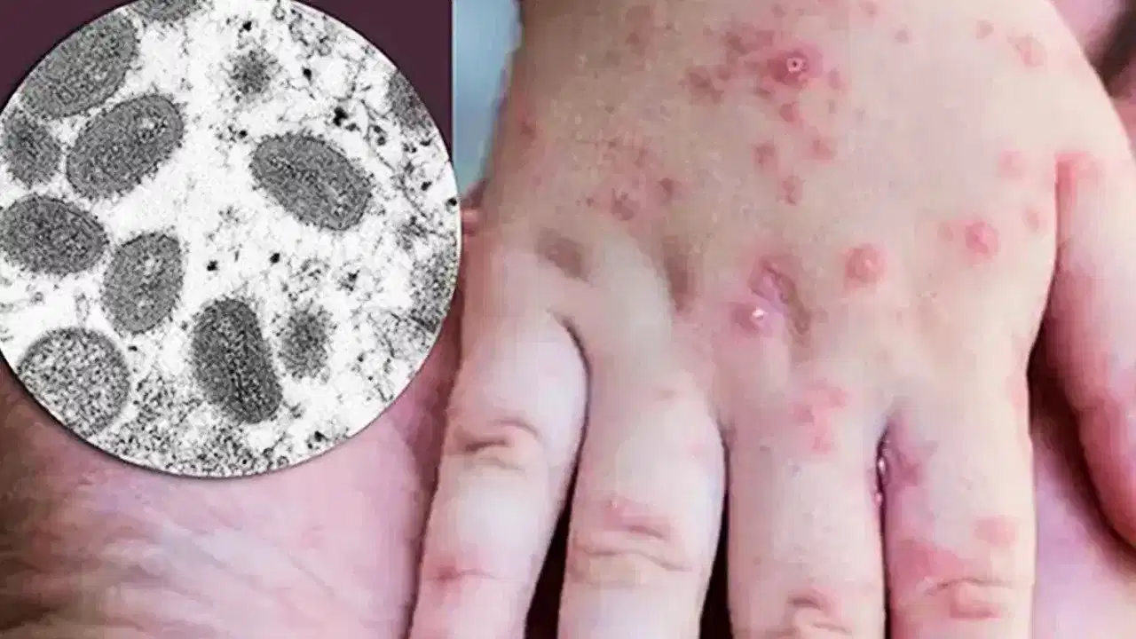 Monkey pox:বিশ্বত সন্ত্ৰাসৰ সৃষ্টি কৰা মাংকি পক্স ভাইৰাছ কি?  জানক ইয়াৰ লক্ষণ, কাৰণ আদি সকলো...