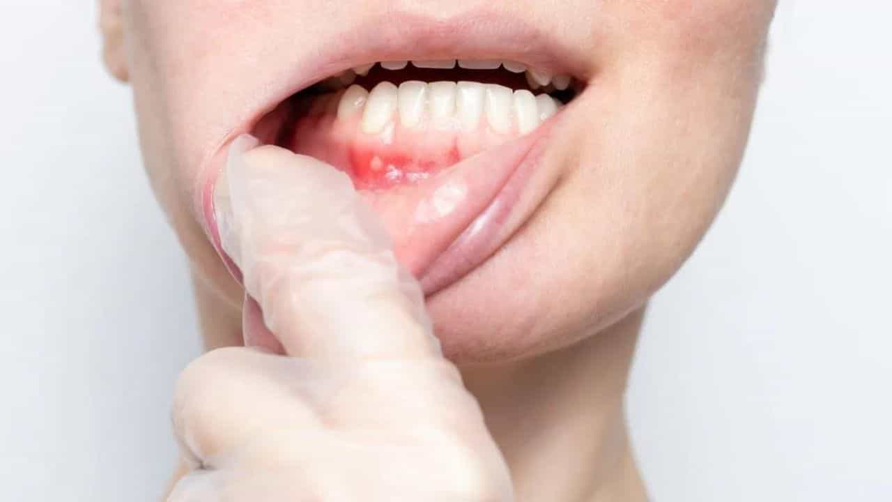 Mouth Ulcers : মুখৰ আলচাৰ পৰা সকাহ পাবলৈ কি কৰিব ? জানক এই কেইটা ঘৰুৱা উপায়...