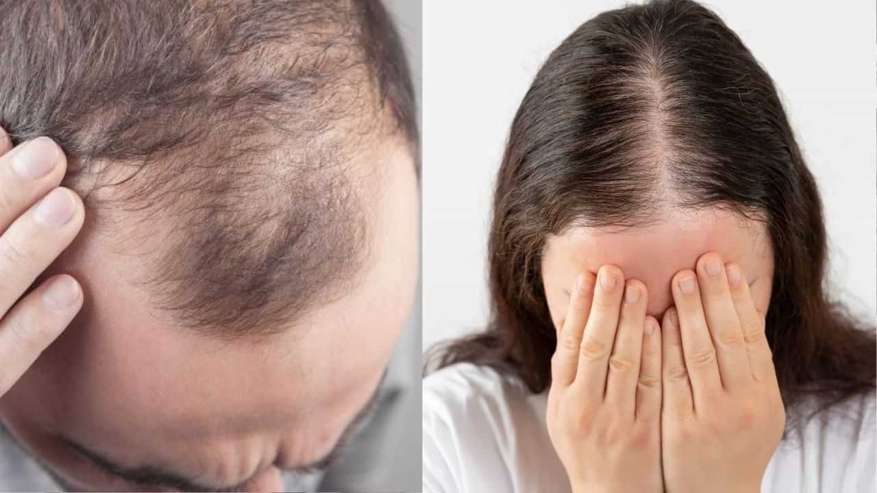 Hair Care Tips: কম বয়সতে চুলি সৰা সমস্যাৰ ভুক্তভোগী হৈছে নেকি? জানক ইয়াৰ ৩টা ডাঙৰ কাৰণ..