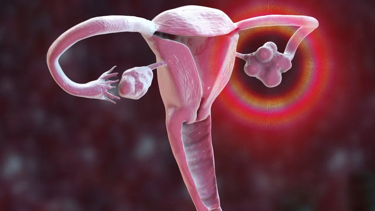 ৩০ বছৰ বয়সৰ পিছত কিয় একাংশ মহিলাৰ PCOS ৰ সমস্যাই দেখা দিয়ে? জানক সমাধানৰ উপায় ৩০ বছৰ বয়সৰ পিছত কিয় একাংশ মহিলাৰ PCOS ৰ সমস্যাই দেখা দিয়ে? জানক সমাধানৰ উপায়