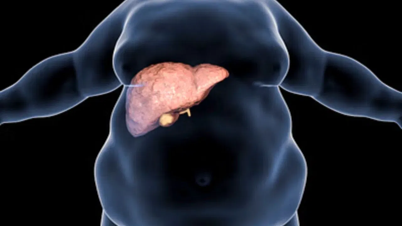 Fatty Liver: কেৱল মদ্যপান নহয়, এই ৫টা সাধাৰণ অভ্যাসৰ বাবেও হয় ফেটি লিভাৰ, জানক…. Fatty Liver: কেৱল মদ্যপান নহয়, এই ৫টা সাধাৰণ অভ্যাসৰ বাবেও হয় ফেটি লিভাৰ, জানক….