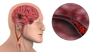 ব্ৰেইন ষ্ট্ৰোকৰ প্ৰাৰম্ভিক ৩টা লক্ষণ কি কি? প্ৰতিৰোধৰ উপায় জানক…