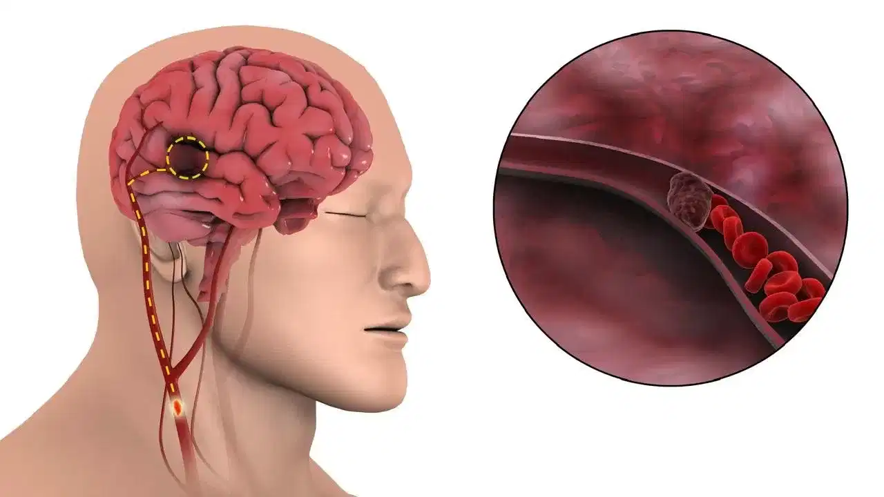 ব্ৰেইন ষ্ট্ৰোকৰ প্ৰাৰম্ভিক ৩টা লক্ষণ কি কি? প্ৰতিৰোধৰ উপায় জানক... ব্ৰেইন ষ্ট্ৰোকৰ প্ৰাৰম্ভিক ৩টা লক্ষণ কি কি? প্ৰতিৰোধৰ উপায় জানক...