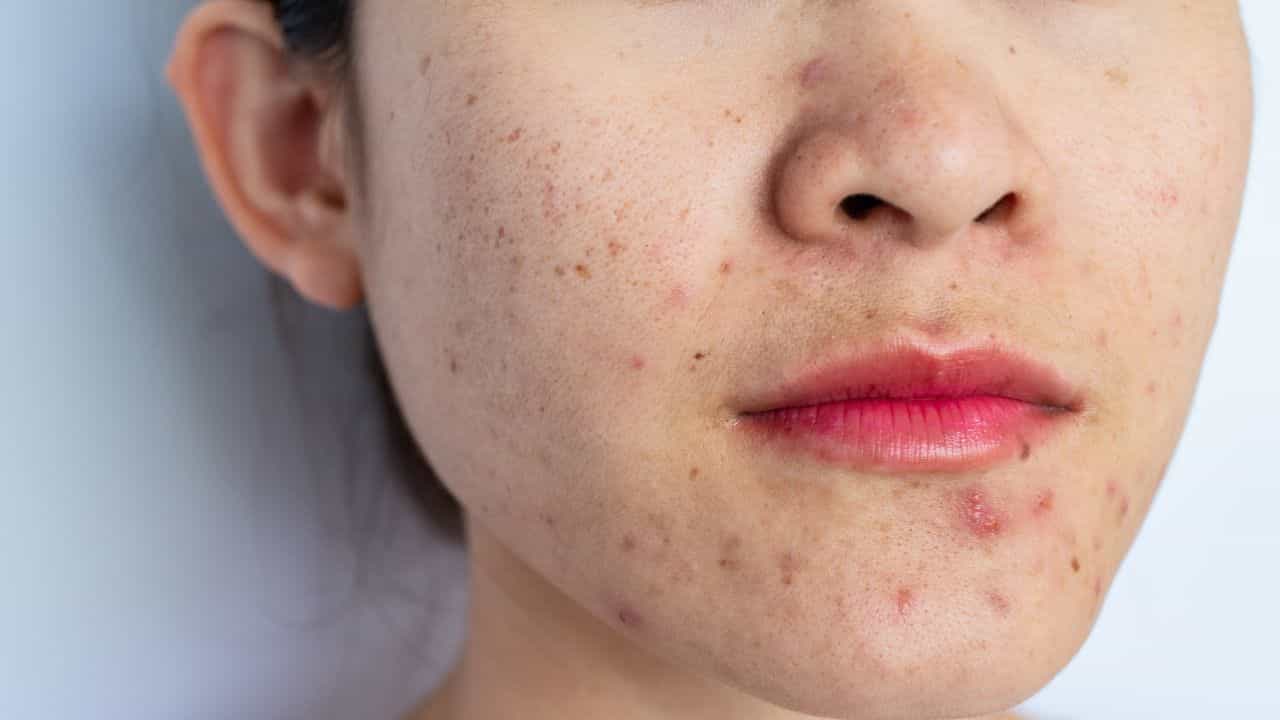 Tips for oily skin: আপোনাৰ মুখৰ ছাল তেলীয়া নেকি ? যত্ন লওক এইদৰে... Tips for oily skin: আপোনাৰ মুখৰ ছাল তেলীয়া নেকি ? যত্ন লওক এইদৰে...