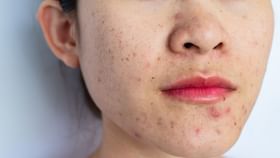 Tips for oily skin: আপোনাৰ মুখৰ ছাল তেলীয়া নেকি ? যত্ন লওক এইদৰে… Tips for oily skin: আপোনাৰ মুখৰ ছাল তেলীয়া নেকি ? যত্ন লওক এইদৰে…...