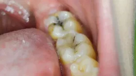 Dental Health: পোকে খাইছে নেকি আপোনাৰ দাঁত? পাকঘৰৰ ২টা সামগ্ৰীৰে দূৰ কৰক দাঁতৰ সমস্যা Dental Health: পোকে খাইছে নেকি আপোনাৰ দাঁত? পাকঘৰৰ ২টা সামগ্ৰীৰে দূৰ কৰক দাঁতৰ সমস্যা...