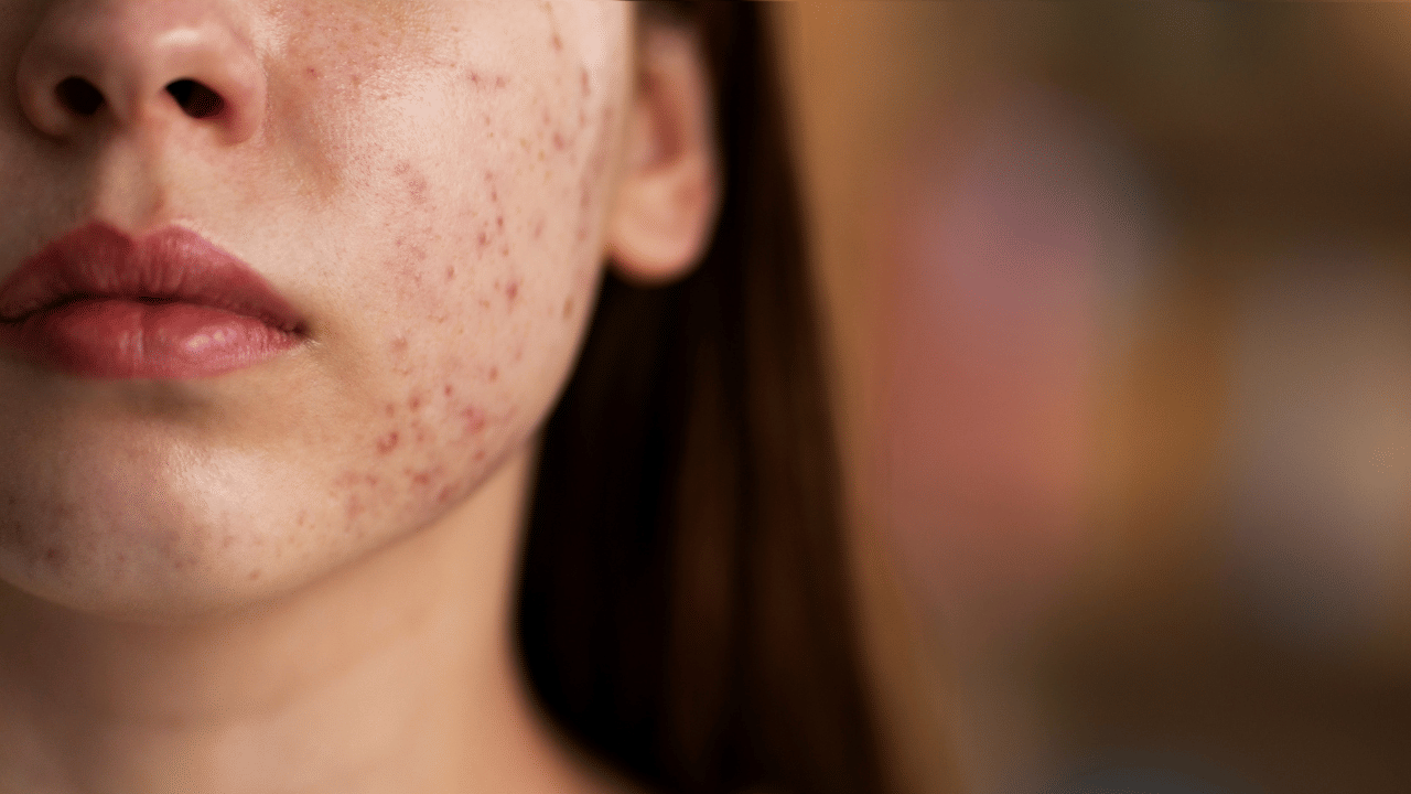 বাৰে বাৰে মুখত শালমইনা ওলাই নেকি? তেন্তে খাওক এইসমূহ খাদ্য, দূৰ হব সকলো সমস্যা...