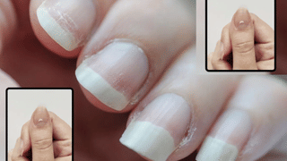 নখত দেখা দিয়া লক্ষণ হ’ব পাৰে কৰ্কট ৰোগৰ ইংগিত! জানক সকলো..