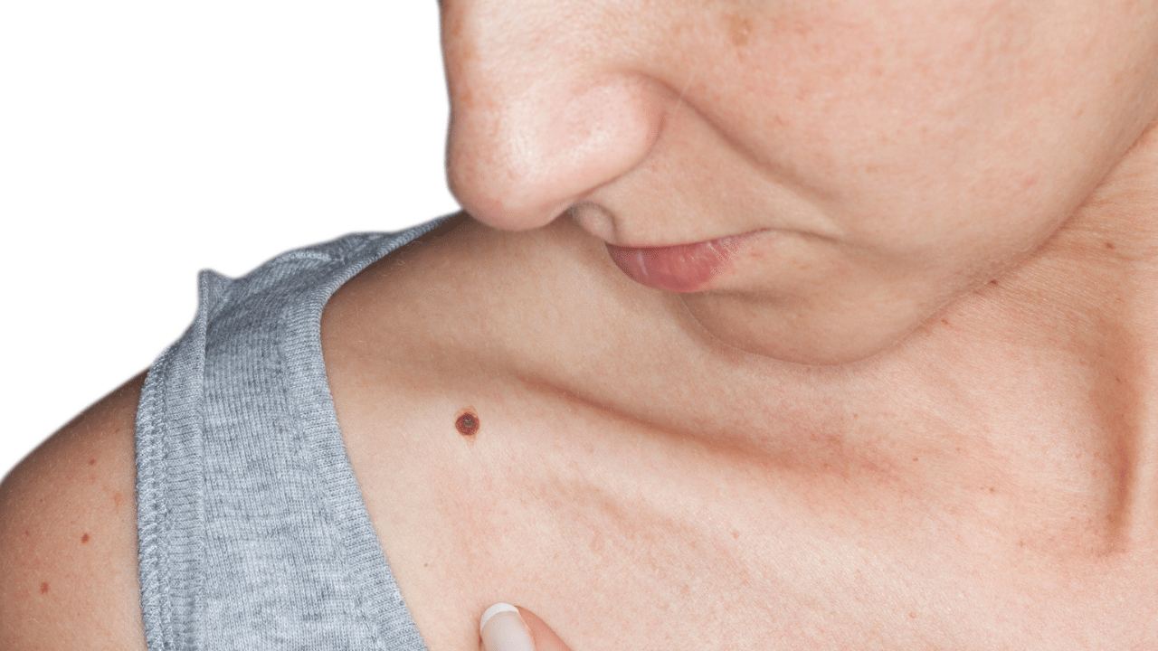 ছালৰ কৰ্কট ৰোগ হলে কি কি লক্ষণে দেখা দিয়ে? কোনসকলৰ আশংকা বেছি, জানক বিশেষজ্ঞৰ পৰা... ছালৰ কৰ্কট ৰোগ হলে কি কি লক্ষণে দেখা দিয়ে? কোনসকলৰ আশংকা বেছি, জানক বিশেষজ্ঞৰ পৰা...