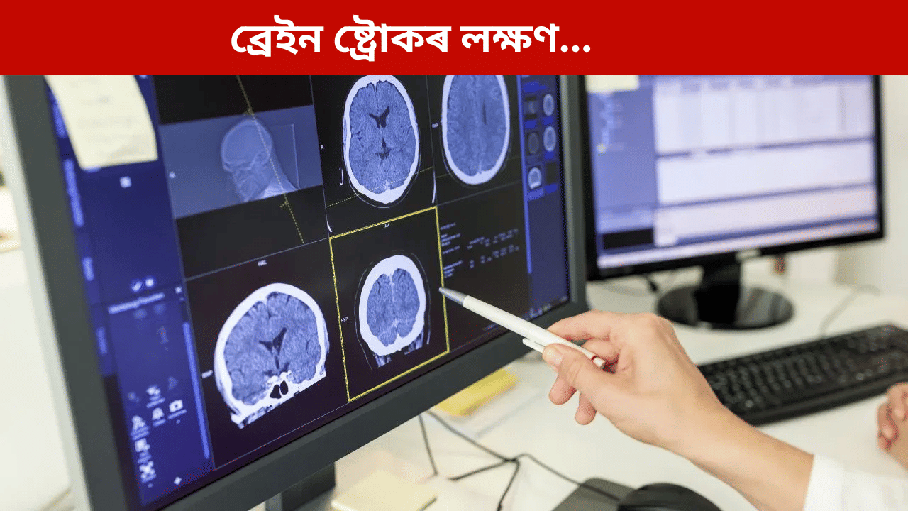 কোনসকল লোকৰ ব্ৰেইন ষ্ট্ৰোক হোৱাৰ আশংকা বেছি? জানক চিকিৎসকৰ পৰা... কোনসকল লোকৰ ব্ৰেইন ষ্ট্ৰোক হোৱাৰ আশংকা বেছি? জানক চিকিৎসকৰ পৰা...