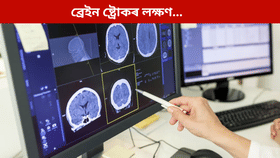 কোনসকল লোকৰ ব্ৰেইন ষ্ট্ৰোক হোৱাৰ আশংকা বেছি? জানক... কোনসকল লোকৰ ব্ৰেইন ষ্ট্ৰোক হোৱাৰ আশংকা বেছি? জানক...