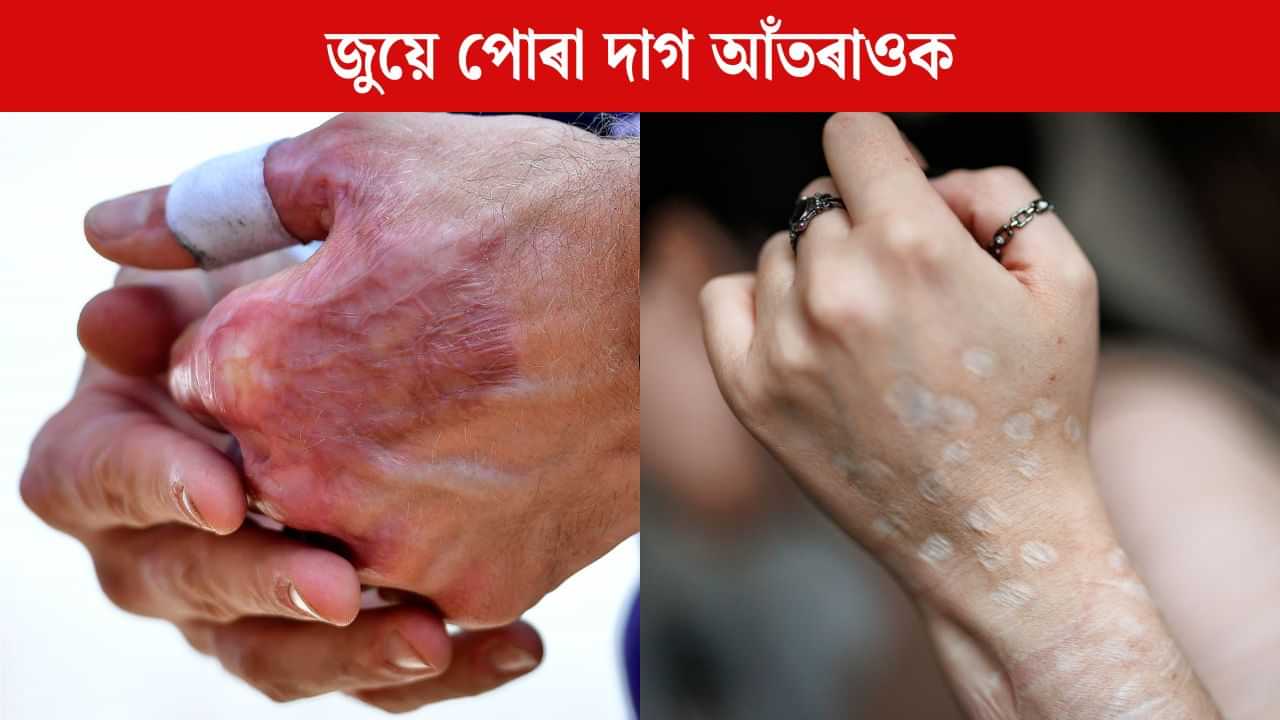 Burn Marks Remove : আপোনাৰ শৰীৰত জুয়ে পোৰা দাগ আছে নেকি? ঘৰুৱা উপায়েৰে কৰক দূৰ Burn Marks Remove : আপোনাৰ শৰীৰত জুয়ে পোৰা দাগ আছে নেকি? ঘৰুৱা উপায়েৰে কৰক দূৰ