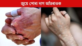 আপোনাৰ শৰীৰত জুয়ে পোৰা দাগ আছে নেকি? ঘৰুৱা উপায়েৰে কৰক দূৰ আপোনাৰ শৰীৰত জুয়ে পোৰা দাগ আছে নেকি? ঘৰুৱা উপায়েৰে কৰক দূৰ