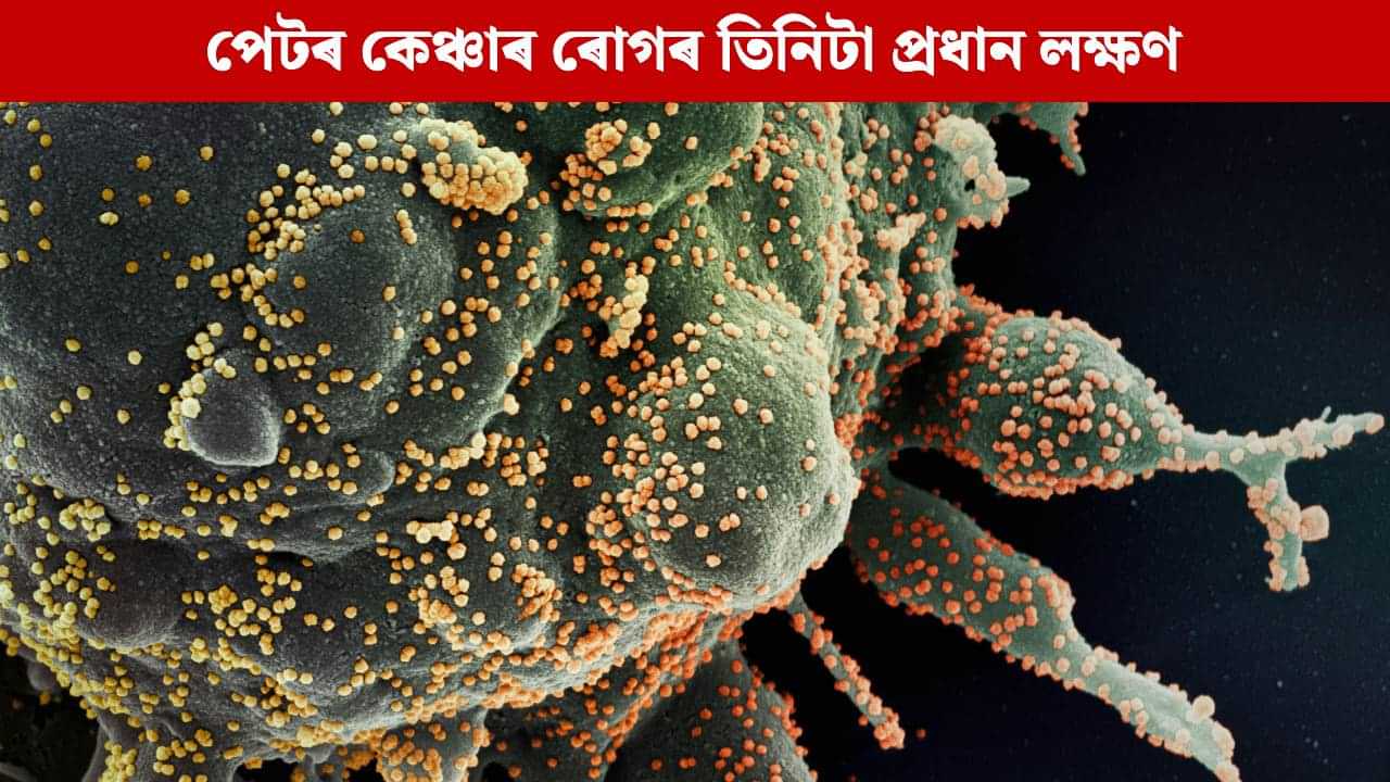 পেটৰ কেঞ্চাৰ ৰোগৰ ক্ষেত্ৰত দেখা দিয়ে এই তিনিটা প্ৰধান লক্ষণ, জানি লওক বিশেষজ্ঞৰ পৰা পেটৰ কেঞ্চাৰ ৰোগৰ ক্ষেত্ৰত দেখা দিয়ে এই তিনিটা প্ৰধান লক্ষণ, জানি লওক বিশেষজ্ঞৰ পৰা