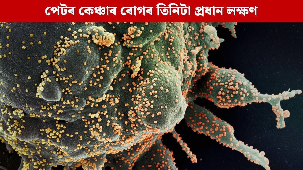 পেটৰ কেঞ্চাৰ ৰোগৰ ক্ষেত্ৰত দেখা দিয়ে এই তিনিটা প্ৰধান লক্ষণ, জানি লওক বিশেষজ্ঞৰ পৰা পেটৰ কেঞ্চাৰ ৰোগৰ ক্ষেত্ৰত দেখা দিয়ে এই তিনিটা প্ৰধান লক্ষণ, জানি লওক বিশেষজ্ঞৰ পৰা