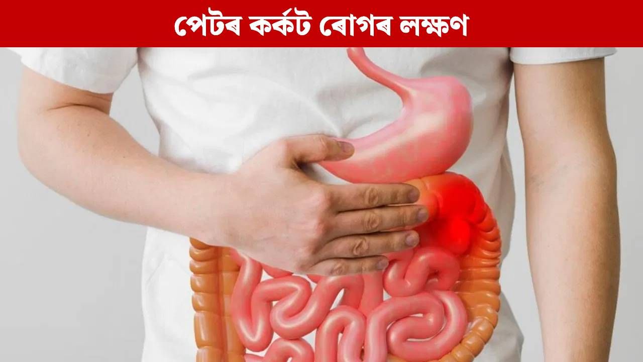 আওকাণ নকৰিব পেটৰ এইসমূহ সাধাৰণ সমস্যা, হ’ব পৰে কৰ্কট ৰোগৰ লক্ষণ… আওকাণ নকৰিব পেটৰ এইসমূহ সাধাৰণ সমস্যা, হ’ব পৰে কৰ্কট ৰোগৰ লক্ষণ…