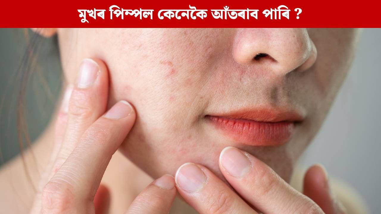 কিয় বাৰে বাৰে মুখত পিম্পলৰ সমস্যা হয় ? কেনেকৈ প্ৰতিৰোধ কৰিব পাৰি? কিয় বাৰে বাৰে মুখত পিম্পলৰ সমস্যা হয় ? কেনেকৈ প্ৰতিৰোধ কৰিব পাৰি?