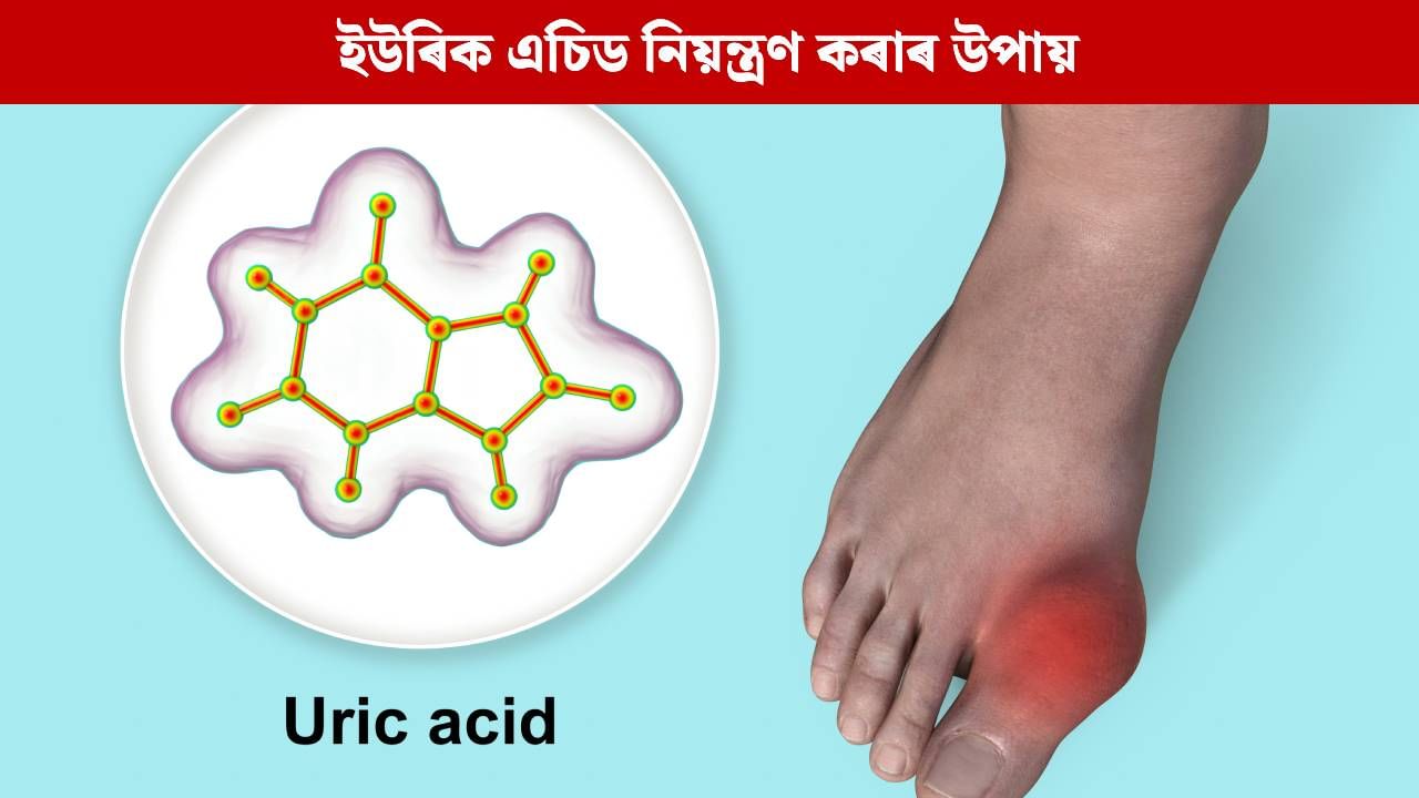 কিয় বাৰে বাৰে ইউৰিক এচিডৰ মাত্ৰা বৃদ্ধি পায় ? ইয়াক কেনেকৈ নিয়ন্ত্ৰণ কৰিব পাৰি ? চিকিৎসকৰ পৰা জানক