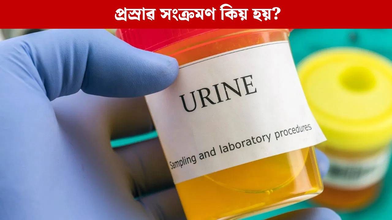 Urine Infection: বাৰে বাৰে হয় নেকি প্ৰস্ৰাৱৰ সংক্ৰমণ? কিয় হয়, সকাহ লাভৰ উপায়… Urine Infection: বাৰে বাৰে হয় নেকি প্ৰস্ৰাৱৰ সংক্ৰমণ? কিয় হয়, সকাহ লাভৰ উপায়…