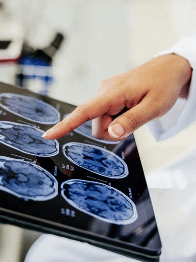 নকৰিব আওকান! ব্ৰেইন টিউমাৰৰ ৬টা প্ৰাৰম্ভিক লক্ষণ, জানক… নকৰিব আওকান! ব্ৰেইন টিউমাৰৰ ৬টা প্ৰাৰম্ভিক লক্ষণ, জানক…