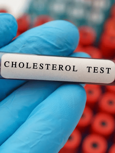 কলেষ্টেৰল বৃদ্ধি হ’লে ছালত কি লক্ষণে দেখা দিয়ে, জানক সকলো… কলেষ্টেৰল বৃদ্ধি হ’লে ছালত কি লক্ষণে দেখা দিয়ে, জানক সকলো…