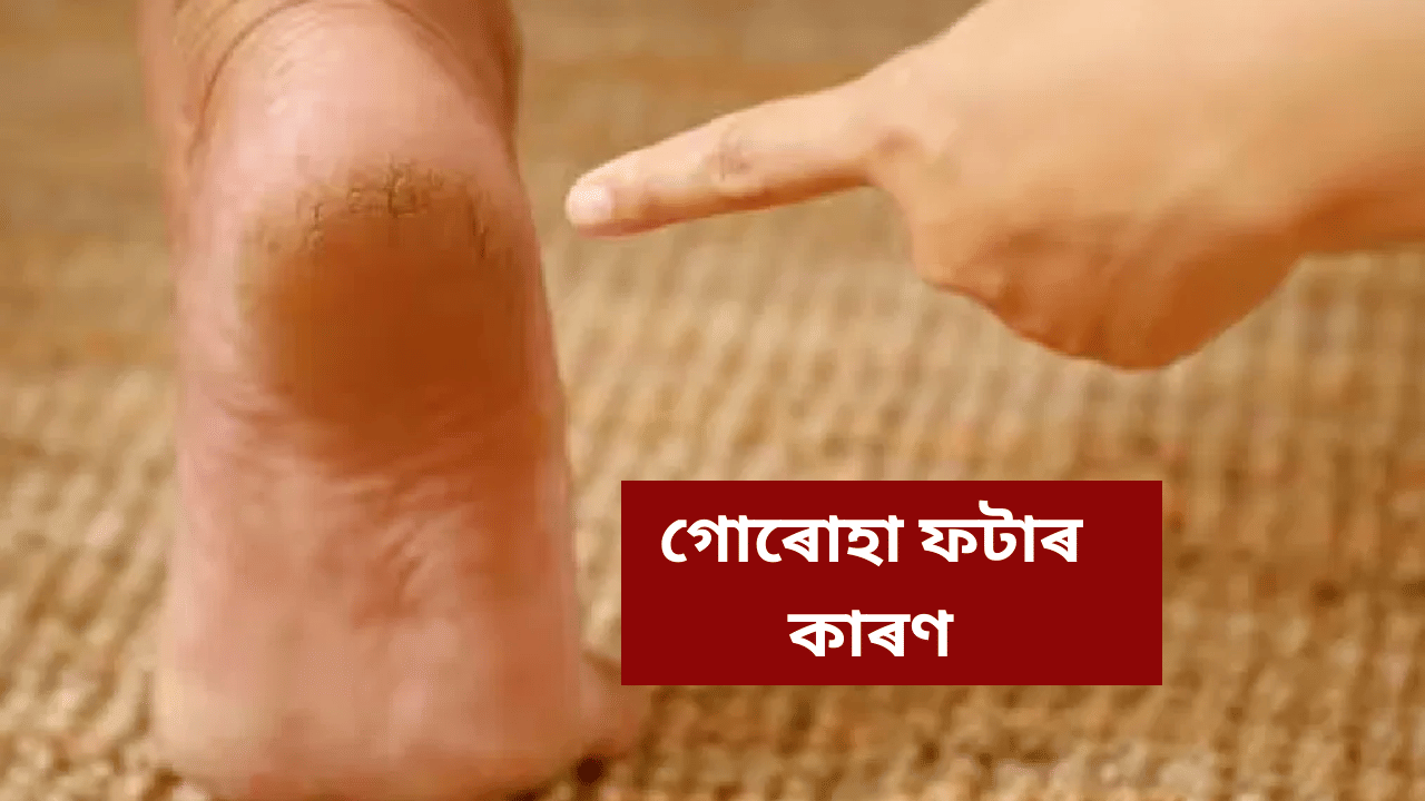 Cracked Heels Cause (1)