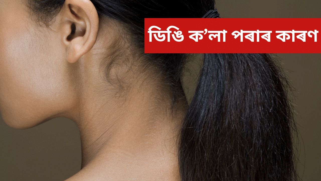 ডিঙি ক’লা পৰা, ভৰি ফুলা… হ’ব পাৰে এই ৰোগৰ লক্ষণ, জানক… ডিঙি ক’লা পৰা, ভৰি ফুলা… হ’ব পাৰে এই ৰোগৰ লক্ষণ, জানক…