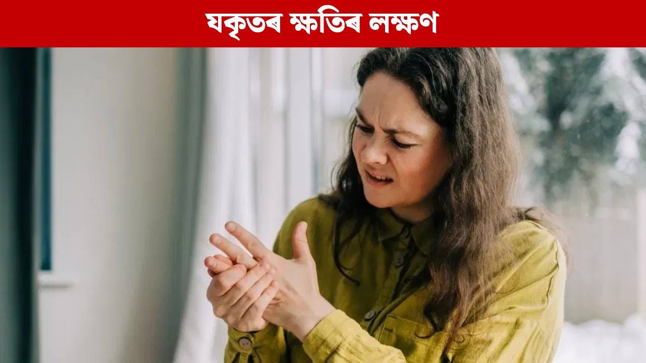 Liver Damage: হাতত দেখা পোৱা এই সমস্যা হ’ব পাৰে যকৃতৰ ক্ষতিৰ লক্ষণ, অধিক জানক Liver Damage: হাতত দেখা পোৱা এই সমস্যা হ’ব পাৰে যকৃতৰ ক্ষতিৰ লক্ষণ, অধিক জানক