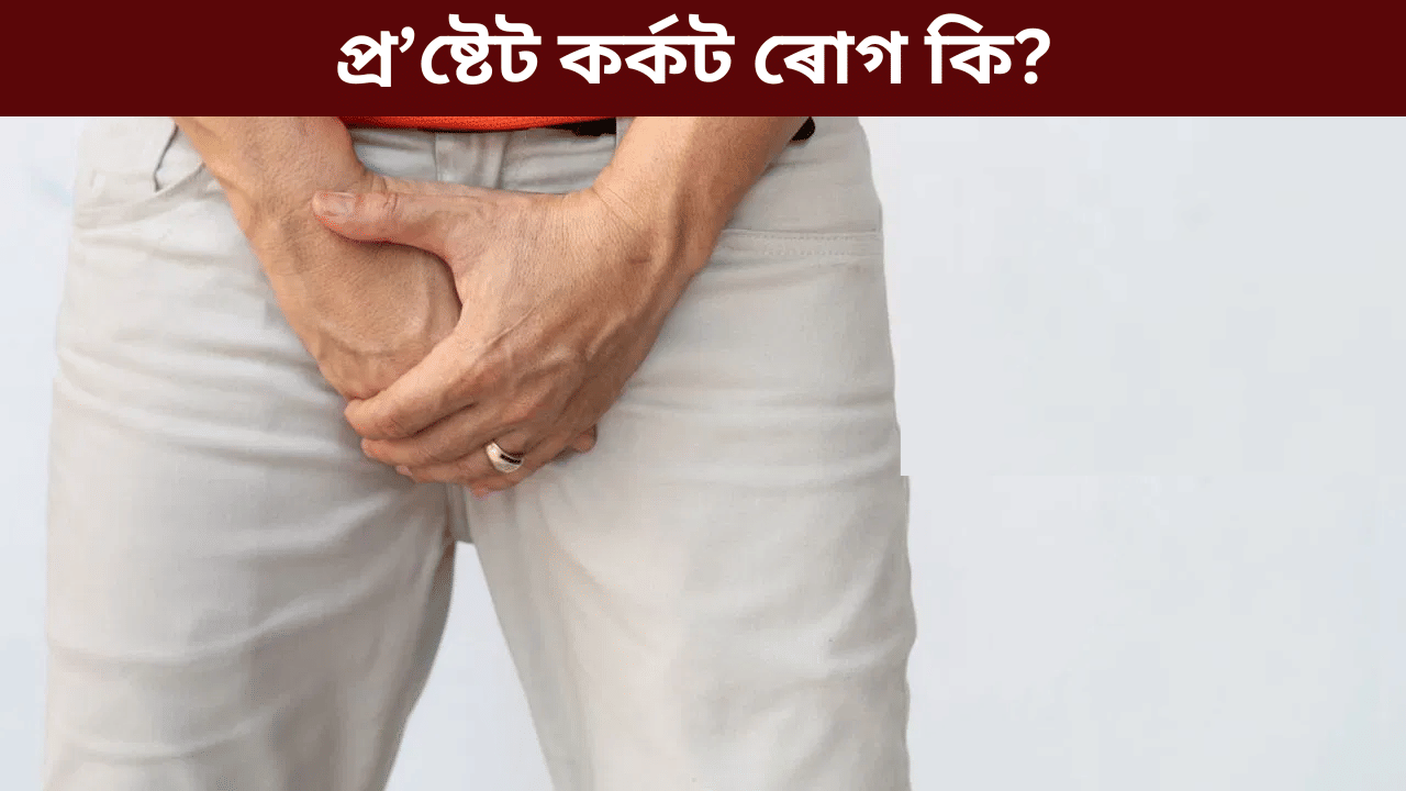 পুৰুষসকলৰ কিয় প্ৰ’ষ্টেট কেন্সাৰ হয়? ইয়াৰ লক্ষণ কি, জানক চিকিৎসকৰ পৰা…