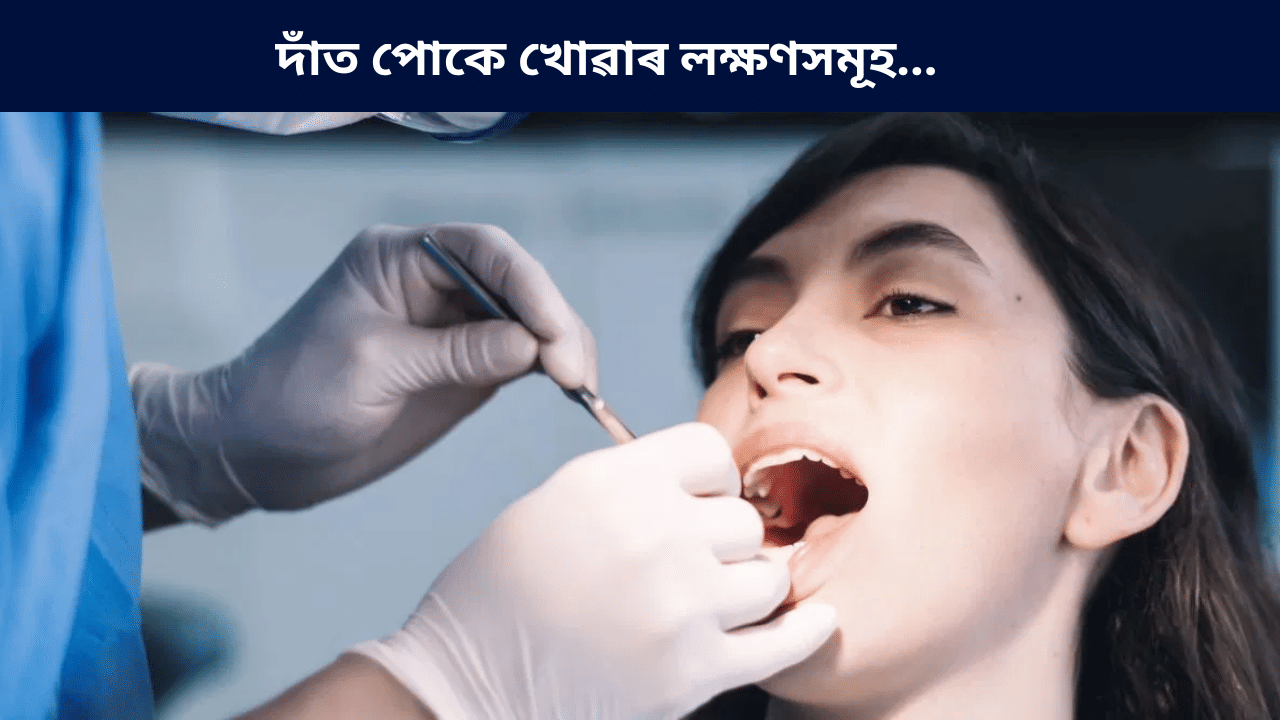 Teeth cavities: দাঁত পোকে খোৱাৰ কাৰণ আৰু লক্ষণ কি? জানক চিকিৎসকৰ পৰা…