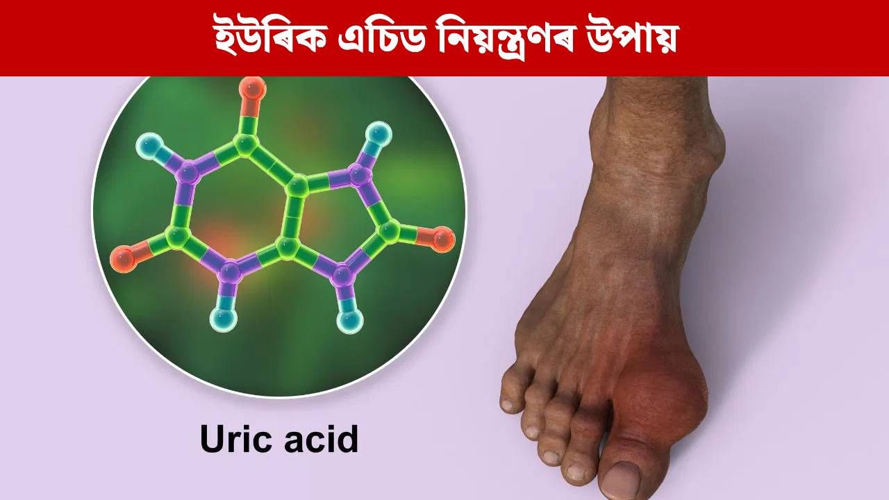 Uric Acid: ইউৰিক এচিড বৃদ্ধি হ’লে দেখা দিয়ে এইসমূহ সাধাৰণ লক্ষণ, কেনেকৈ নিয়ন্ত্ৰণ কৰিব? Uric Acid: ইউৰিক এচিড বৃদ্ধি হ’লে দেখা দিয়ে এইসমূহ সাধাৰণ লক্ষণ, কেনেকৈ নিয়ন্ত্ৰণ কৰিব?