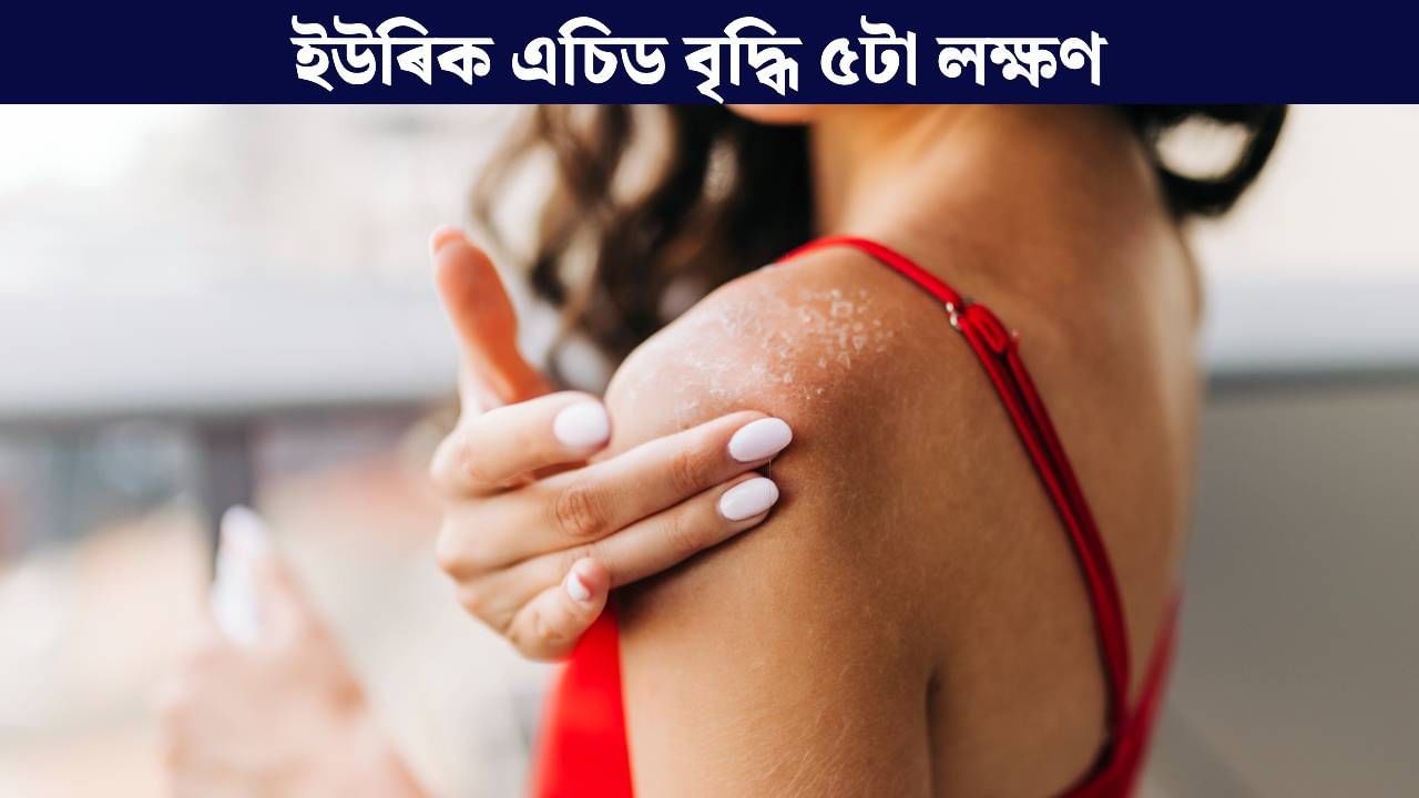 ইউৰিক এচিড বৃদ্ধি হ’লে ছালত দেখা যায় এই ৫টা লক্ষণ, কি কৰিব?