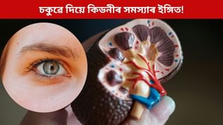 আপোনাৰ চকুৱে দিয়ে কিডনীৰ সমস্যাৰ ইঙ্গিত! চকুত এই ৪টা সমস্যা দেখিলেই হওক সাৱধান