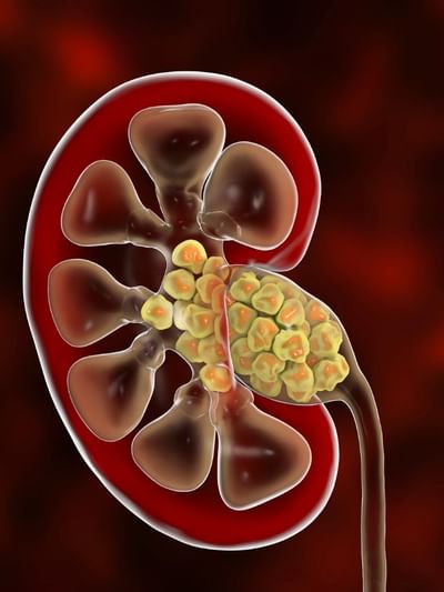 কিডনী ষ্টোন হ’লে কি কৰিব ? কম সময়ত উপশম পোৱাৰ উপায় জানক