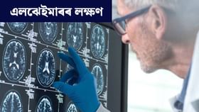 সৰু সৰু কথা পাহৰি যোৱাটো স্বাভাৱিক নে এলঝেইমাৰৰ লক্ষণ?
