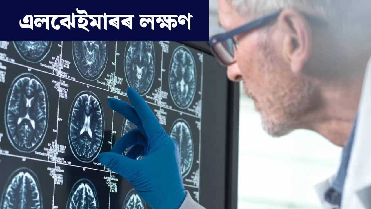 Alzheimers: সৰু সৰু কথা পাহৰি যোৱাটো স্বাভাৱিক নে এলঝেইমাৰৰ লক্ষণ? সবিশেষ জানক...