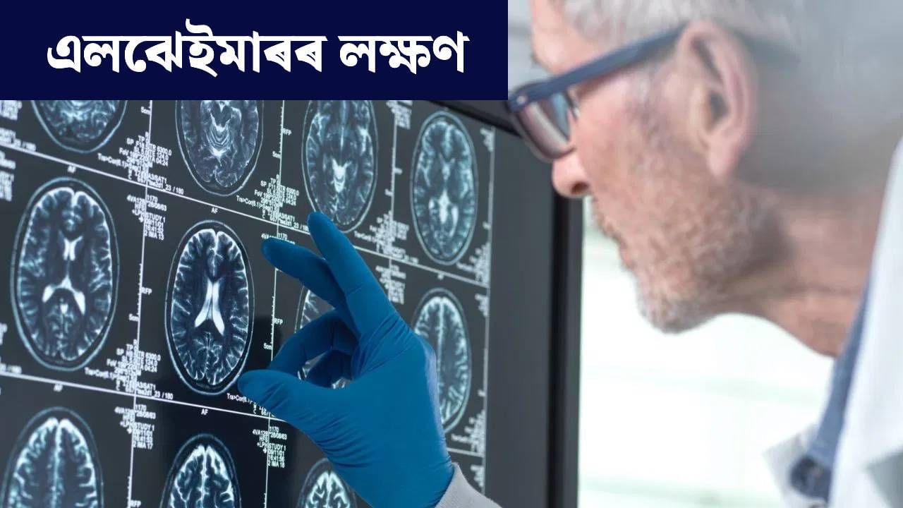 Alzheimers: সৰু সৰু কথা পাহৰি যোৱাটো স্বাভাৱিক নে এলঝেইমাৰৰ লক্ষণ? সবিশেষ জানক…