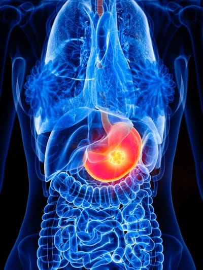 এনে সমস্যা হ’ব পাৰে পেটৰ কৰ্কট ৰোগৰ লক্ষণ! বিপদৰ পূৰ্বেই হওক সাৱধান