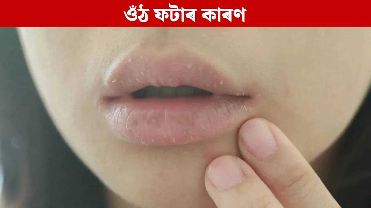 Lips: শীতকালত এইসকল লোকৰ বেছিকৈ ফাটে ওঁঠ, সাৱধান হওক... Lips: শীতকালত এইসকল লোকৰ বেছিকৈ ফাটে ওঁঠ, সাৱধান হওক...
