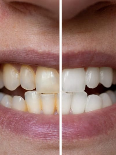 আপোনাৰ দাঁতবোৰ হালধীয়া হৈ পৰিছে নেকি? পৰিষ্কাৰ কৰা চাৰিটা ঘৰুৱা উপায় জানক