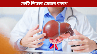 Fatty Liver Cause: সুৰাপান নকৰা লোকসকলৰ কিয় ফেটি লিভাৰ হয়? জানক ৫টা কাৰণ…