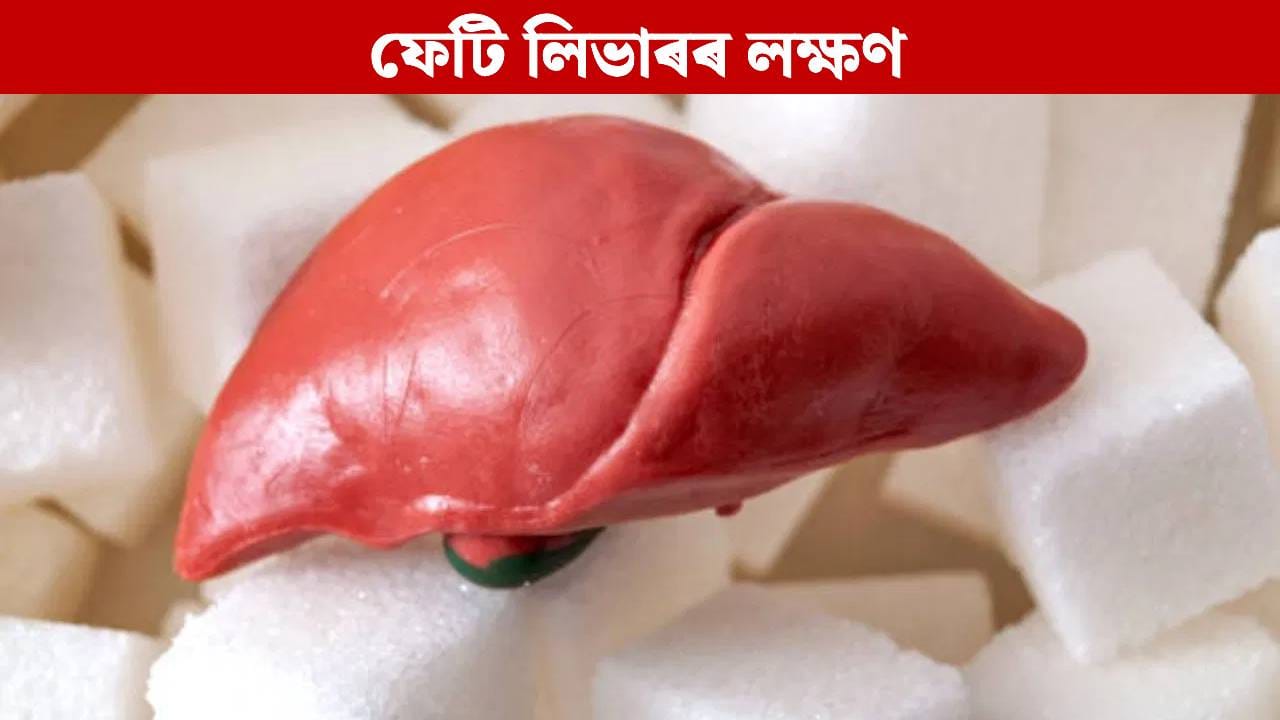 Fatty liver: ফেটি লিভাৰৰ প্ৰাৰম্ভিক পৰ্যায়ত মুখত এইবোৰ লক্ষণে দেখা দিয়ে, জানক…