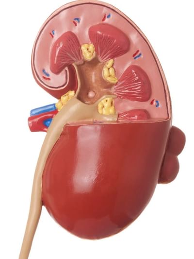 কিডনী ষ্টোন হ’লে কি কৰিব? উপশম পোৱাৰ ঘৰুৱা উপায় জানক