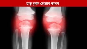 কি কাৰণত হাড় দুৰ্বল হ'ব পাৰে ? এই সমস্যা ৰোধ কৰাৰ উপায় জানক