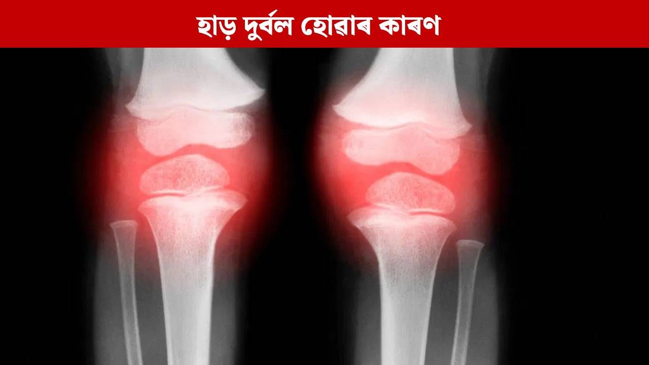 কি কাৰণত হাড় দুৰ্বল হ’ব পাৰে ? এই সমস্যা ৰোধ কৰাৰ উপায় জানক