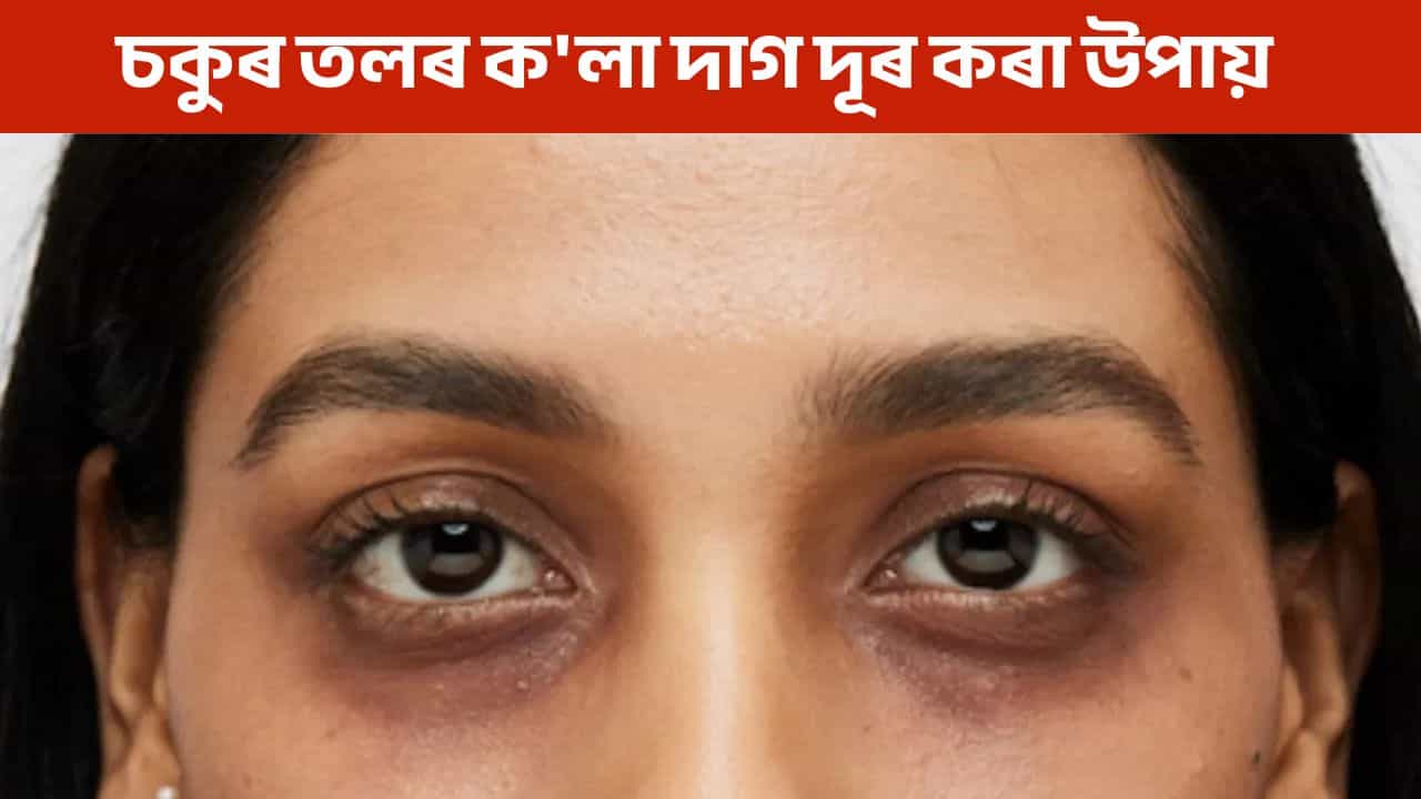 শীতকালত চকুৰ তলত কলা দাগ পৰিছে নেকি? জানক কেনেকৈ কৰিব দূৰ!