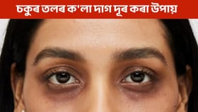শীতকালত চকুৰ তলত ক’লা দাগ পৰিছে নেকি? জানক কেনেকৈ কৰিব দূৰ!...